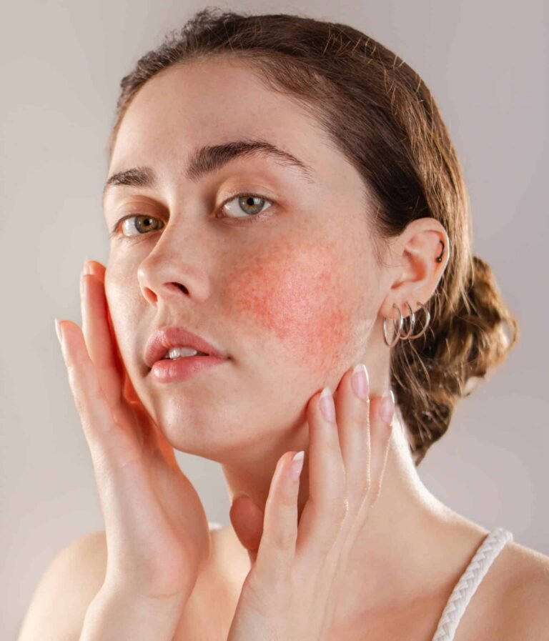 Couperose/ Rosacea