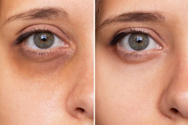 Global Eyecon treatment