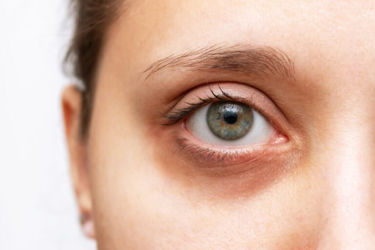 Global Eyecon treatment
