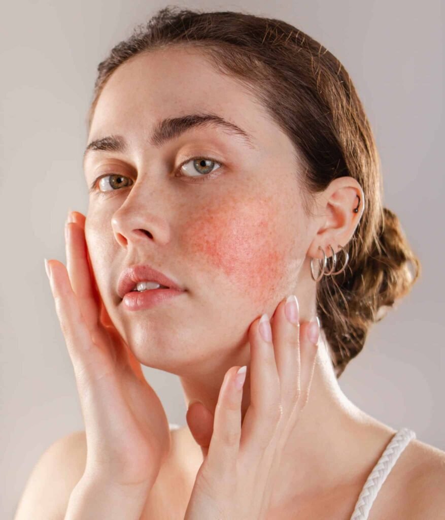 rosacea