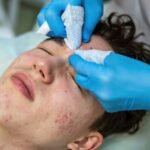 Acne & Onzuiverheden